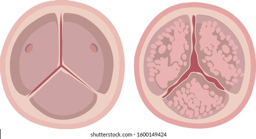 Aortic Valve Calcification, Stenosis, Tight Aortic Valve Compared With Normal Aortic Valve