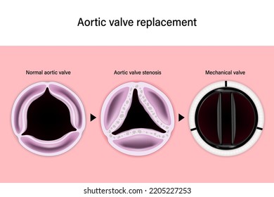 Aortic Valve Replacement. Normal And Aortic Valve Stenosis. Mechanical Valve. Aortic Valve Repair. 