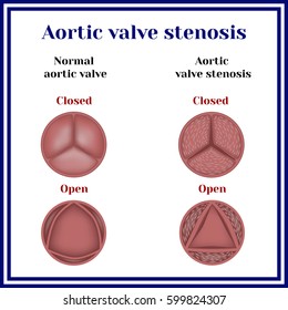 Aortic Valve Stenosis.