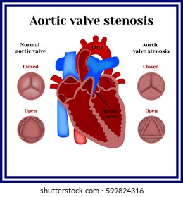 Aortic Valve Stenosis.