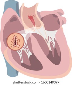 Aortic Valve Stenosis Illustration With Systolic Murmur