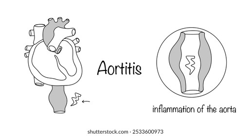 Aortite. Um processo inflamatório envolvendo as paredes da aorta. Um coração desenhado à mão com uma aorta inflamada. Ilustração vetorial simples para uso no campo médico.