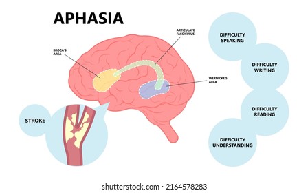 Aphasia Brain Damage Stroke Ischemia Fatty Clots Artery Leaking Attack TIA Trauma Head Tumor Treat Diagnostic Type Global Broca’s Wernicke’s Anomic Mixed Skill Problem Sign Non Fluent Blockage Cell