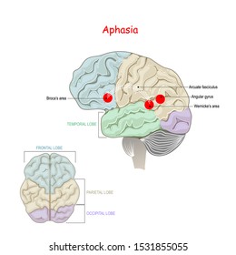 Aphasia. is an inability to comprehend or formulate language. Human Brain with damage to specific areas.