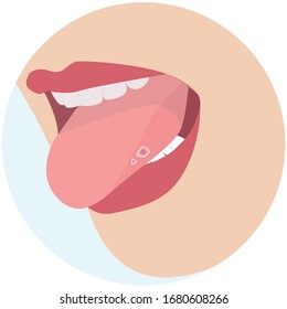 Aphthous mouth ulcers vector illustration