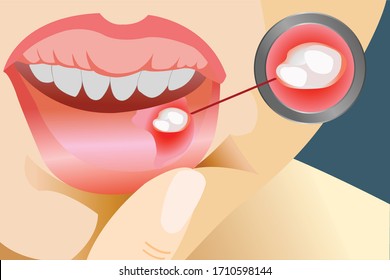 Aphthous ulcers on mouth close up