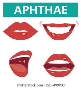 Aphthous ulcers on mouth close up,, vector illustration cartoon flat design clip art