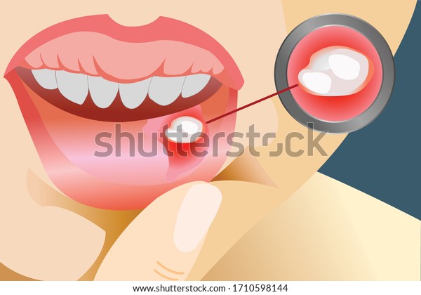 Aphthous ulcers on mouth close\
up