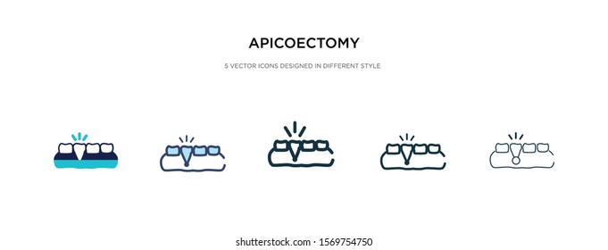 apicoectomy icon in different style vector illustration. two colored and black apicoectomy vector icons designed in filled, outline, line and stroke style can be used for web, mobile, ui