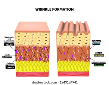 The appearance of wrinkles. Anatomical structure of the skin. Elastin, Hyaluronic acid, Collagen. Infographics. skin aging phenomena. Vector illustration on isolated background