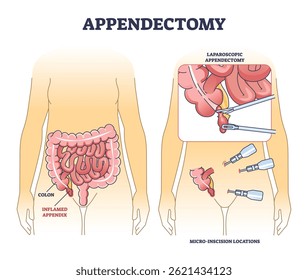 El diagrama de apendicectomía muestra el apéndice inflamado, el colon y las herramientas de cirugía laparoscópica en un esquema médico claro. Esquema del diagrama