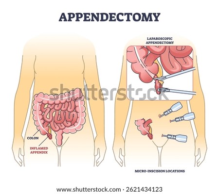 Appendectomy diagram shows the inflamed appendix, colon, and laparoscopic surgery tools in a clear medical outline. Outline diagram
