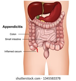 appendicitis 3d medical vector illustration isolated on white background