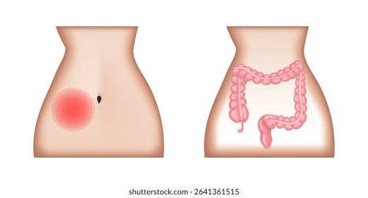 Appendicitis causing lower right abdominal quadrant pain and inflamed appendix