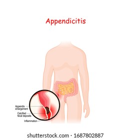 Appendicitis. closeup of appendix with Inflammation. vector illustration. Anatomical diagram with intestine, cecum and lumen. Problems with acute digestive system.