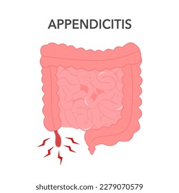 Appendicitis concept vector illustration. Inflammation of appendix.