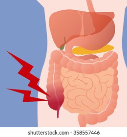 appendicitis and human digestive organs, vector illustration