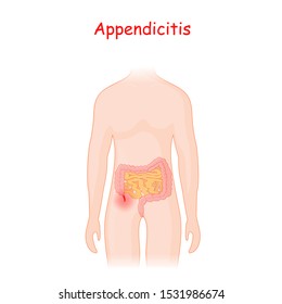 appendicitis. human silhouette with a colon, small intestine and an inflamed appendix. abdomen pain explanation. acute digestive system tract problem.