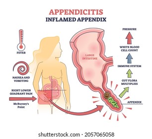 Appendicitis, Inflamed Appendix, Abdominal Medical Problem Diagnosis Outline Diagram. Acute Pain In Lower Right Quadrant Called McBurneys Point. Process In The Large Intestine Producing Pressure.