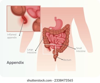  Appendicitis - Apéndice Inflamado - Ilustración de acciones como archivo EPS 10