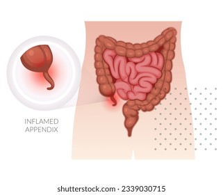  Appendicitis - Apéndice Inflamado - Ilustración de acciones como archivo EPS 10
