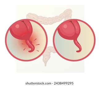  Apendicitis - Apéndice Inflamado - Ilustración de stock como archivo EPS 10