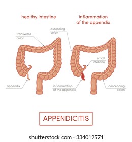 Appendicitis. Inflammation Of The Appendix. Cartoon Vector Illustration For Medical Atlas Or Educational Textbook. 