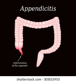 Appendicitis. Inflammation of the appendix. Colon. The illustration on a black background.