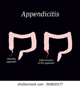 Appendicitis Inflammation Appendix Colon Illustration On Stock Vector ...