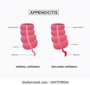 6,139 Appendix Rectum Images, Stock Photos & Vectors | Shutterstock