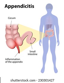 Appendicitis is inflammation of the appendix. Large intestine and appendix highlighted on the silhouette of a human. medical illustration