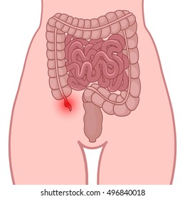 Appendicitis, an inflammation of the appendix, the location of the small and large intestine in the human body