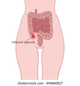 Appendicitis, an inflammation of the appendix, the location of the small and large intestine in the human body