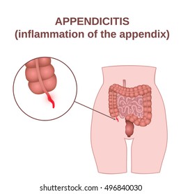 Appendicitis, an inflammation of the appendix, the location of the small and large intestine in the human body
