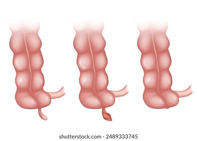 Appendicitis is an inflammation of the appendix. is an inflammation of the appendix. Appendicitis Treatment Surgery. Appendectomy. Laparoscopic Appendix Removal   