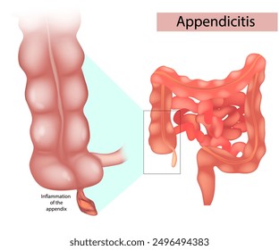 Appendicitis is an inflammation of the appendix. Appendicitis Treatment Surgery. Appendectomy. 