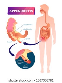 Appendix pain