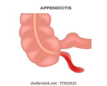 appendicitis vector in white background
