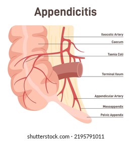 Appendix. Anatomical Diagram With Large Intestine, Caecum And Ileum. Digestive Tract Vestigial Organ. Flat Vector Illustration