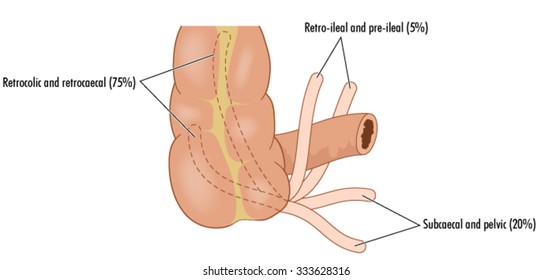 The appendix shown in various different positions and the average occurrences of each.
