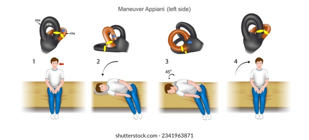 Manejo Appiani, una guía práctica para el tratamiento del vértigo paroxístico posicional benigno (bppv). Con daño en la oreja izquierda. Diagrama de la estructura del oído interior. Vector. 