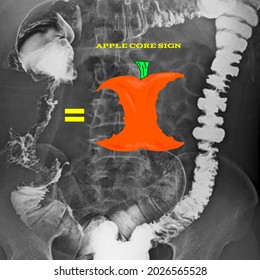 apple core sign colorectal contrast study x ray radiology image