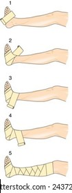 Application of figure of eight bandage