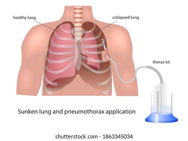 Application of pneumothorax to injured lung
