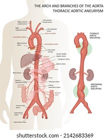 The arch and branches of the aorta. Thoracic aortic aneurysm 