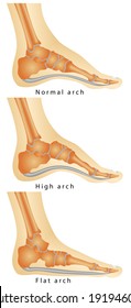 Arch of Foot. Set of flat foot, high arch. Rheumatoid Arthritis In Arch Of Foot. Various stages of the disease on white background