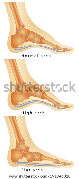 足のアーチ 平足のセット 高いアーチ 足弓関節リウマチ 白い背景に病気のさまざまな段階 のベクター画像素材 ロイヤリティフリー