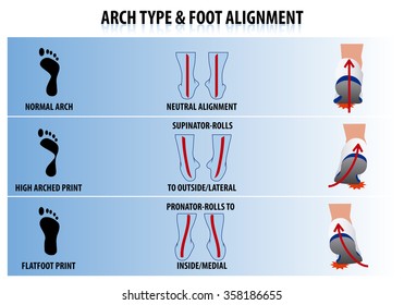 Tipo de arco e alinhamento do pé