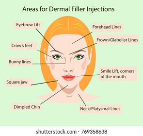 Areas for dermal filler injections