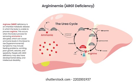 Arginase ARG1 Deficiency vector diagram illustration